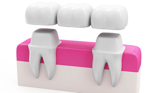 Clínica Dental Gorka Madariaga Prótesis dientes 